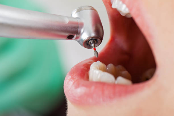 Best Emergency Tooth Extraction in Avalon, CA